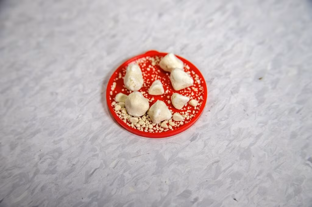 Detailed medical illustration showing the formation of kidney stones in the human renal system